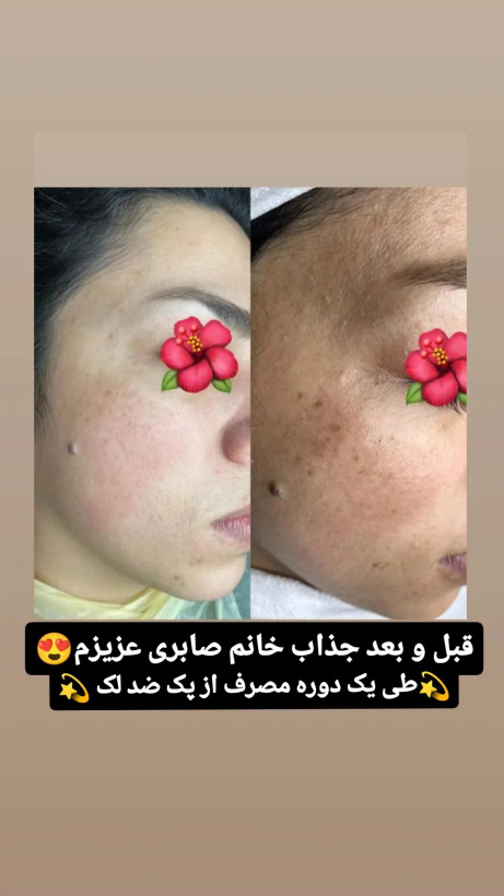ویتامین سی روشن کننده وسفت کننده پوست شما باضمانتنامه اصل بودن